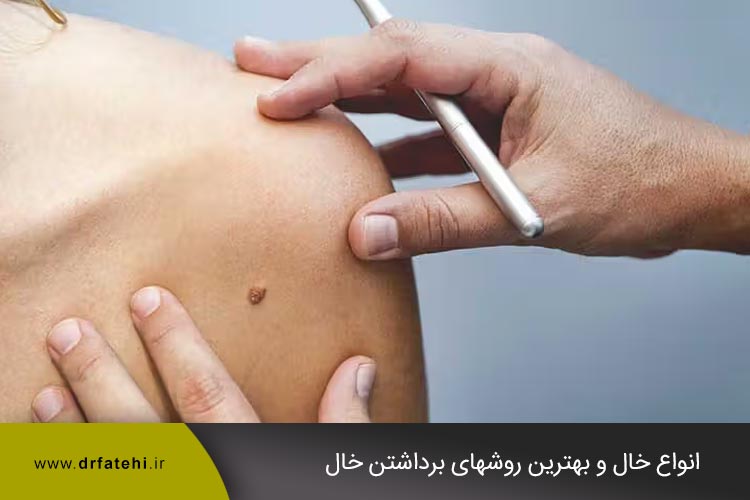 بهترین روشهای برداشتن خال