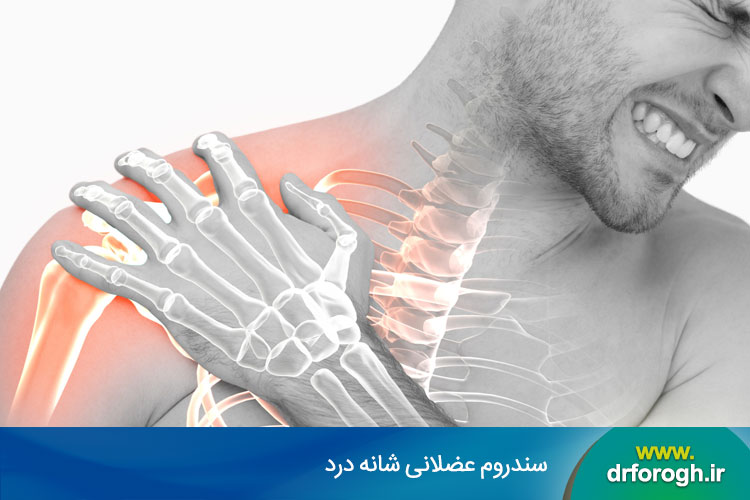 سندرم عضلانی شانه درد