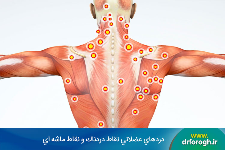 دردهاي عضلاني