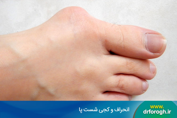 انحراف شست پا