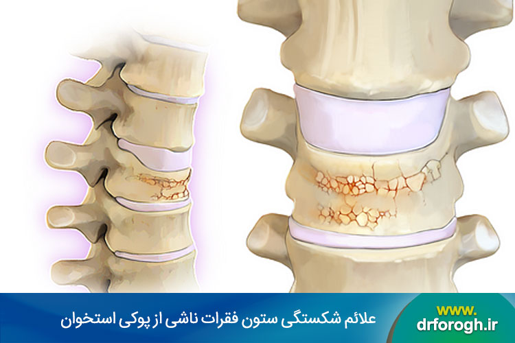 پوکی استخوان و شکستگی ستون فقرات