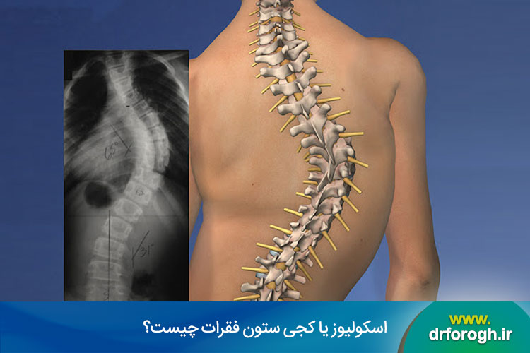 اسکولیوز یا کجی ستون فقرات چیست