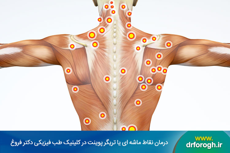 درمان نقاط ماشه ای