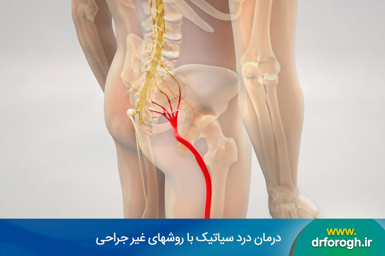 درمان درد سیاتیک با روشهای غیر جراحی