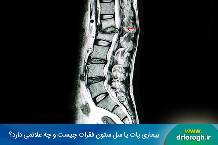 بیماری پات یا سل ستون فقرات