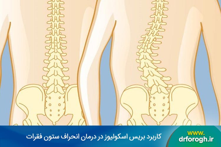 کاربرد بریس اسکولیوز