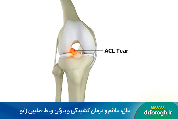 آسیب رباط صلیبی زانو