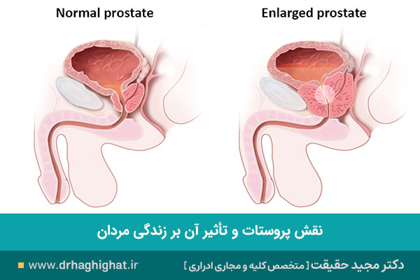 عکس پروستات