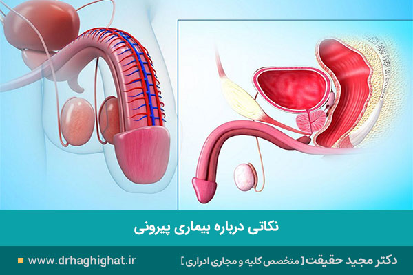 پیرونی و کجی آلت تناسلی