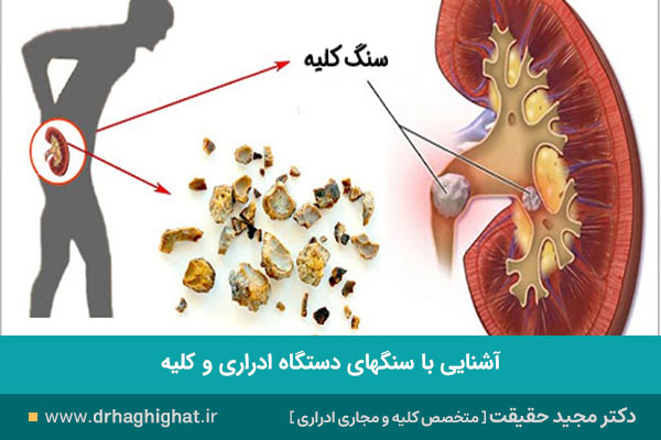 علت سنگ سیستم اداراری و کلیه