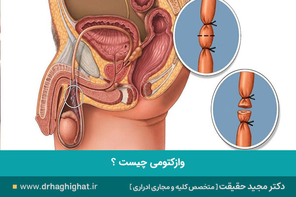 وازکتومی