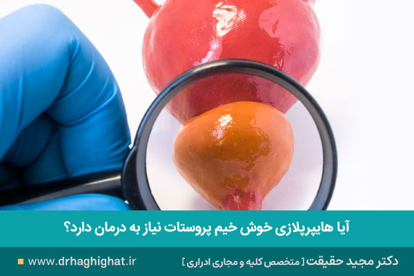 بزرگی خوش خیم پروستات