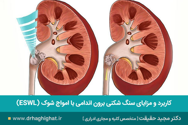 سنگ شکنی کلیه با دستگاه ESWL