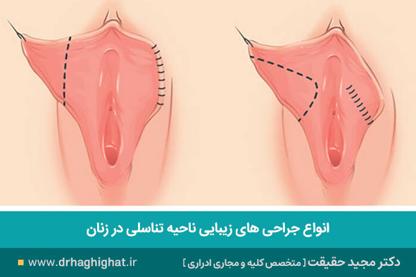 ترمیم زیبایی تناسلی زنان