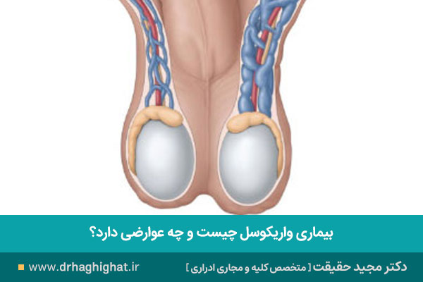 بیماری واریکوسل