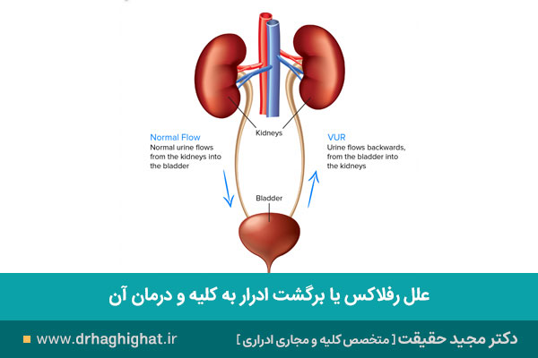 رفلاکس ادراری