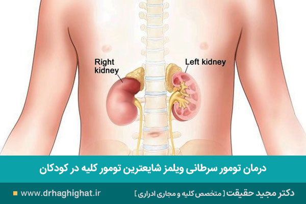 تومور ویلمز