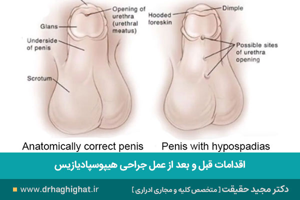 مراقبتهای هیپوسپادیازیس
