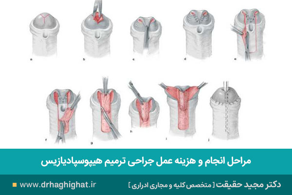 جراحی ترمیم هیپوسپادیازیس