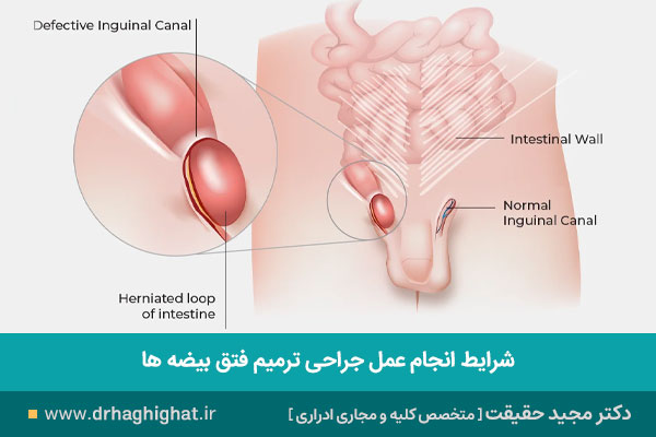 جراحی ترمیم فتق بیضه