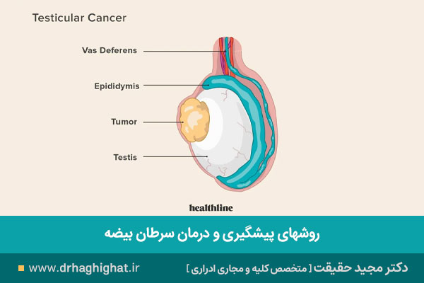 سرطان بیضه