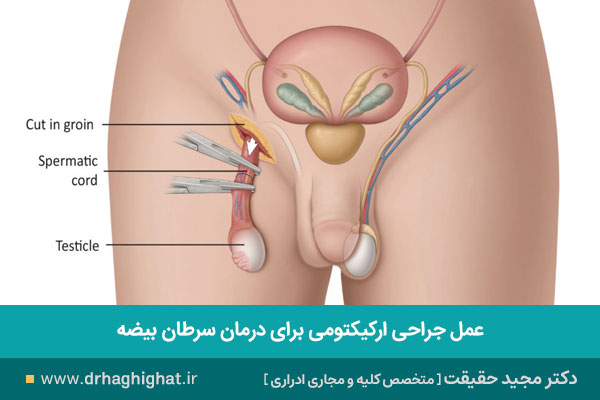 جراحی برداشتن بیضه