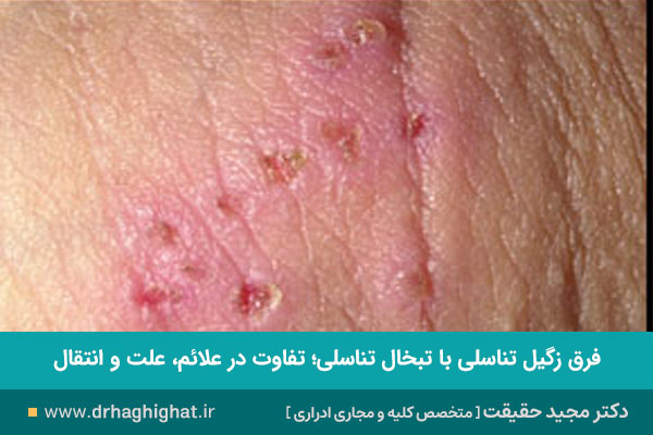 تفاوت تبخال با زگیل تناسلی