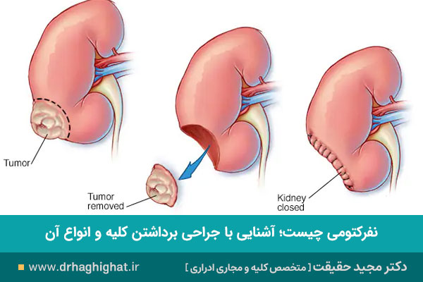 نفرکتومی چیست
