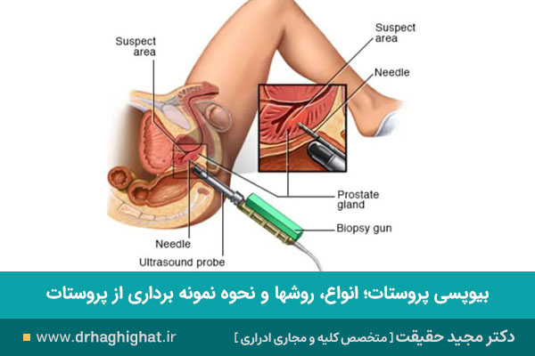 بیوپسی پروستات