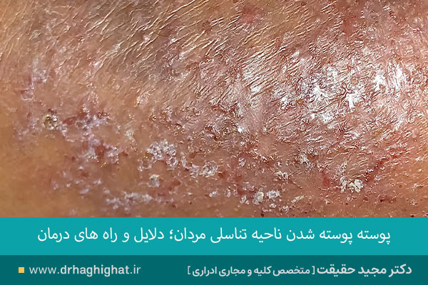 پوسته شدن ناحیه تناسلی مردان