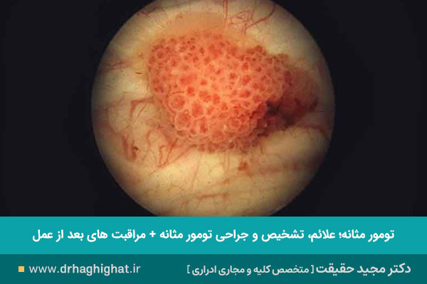تومور مثانه 