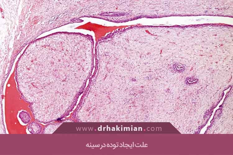 علت ایجاد توده در سینه