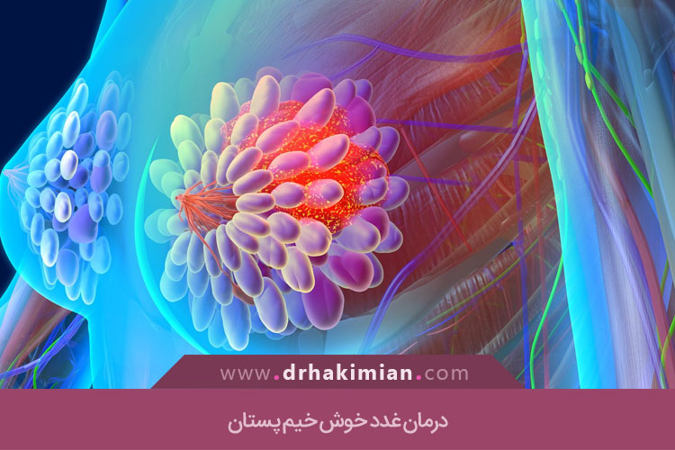 درمان غدد خوش خیم پستان