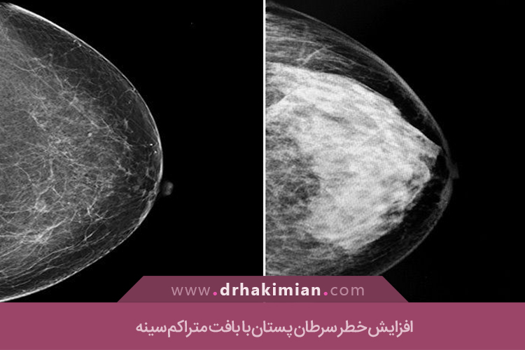 افزایش خطر سرطان پستان 