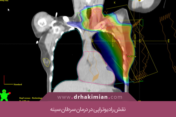 نقش رادیوتراپی در درمان سرطان سینه