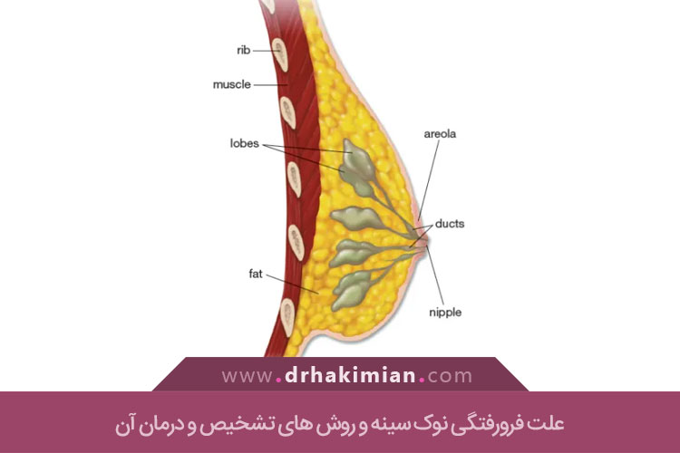 فرورفتگی نوک سینه