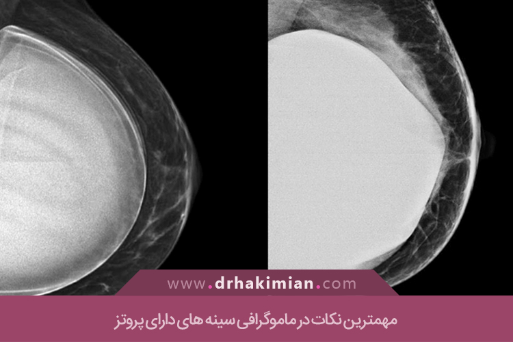مهمترین نکات در ماموگرافی