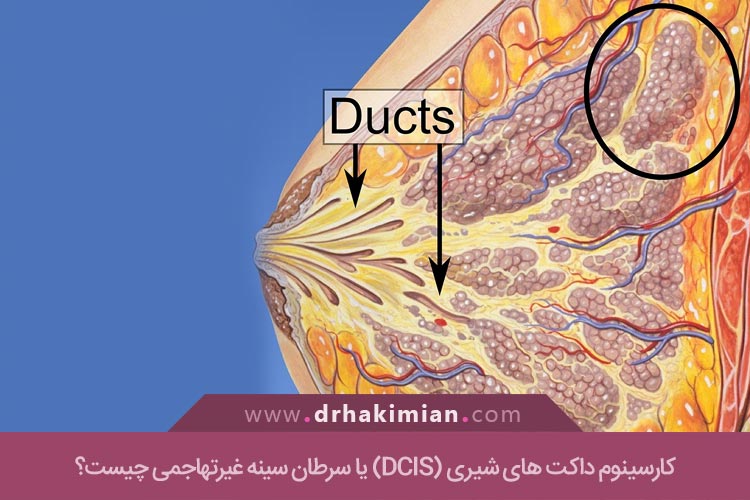 کارسینوم داکت های شیری