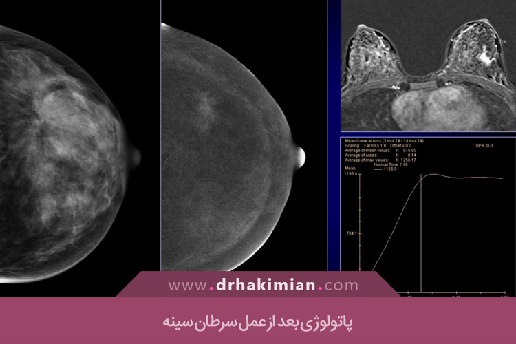 پاتولوژی بعد از عمل سرطان سینه