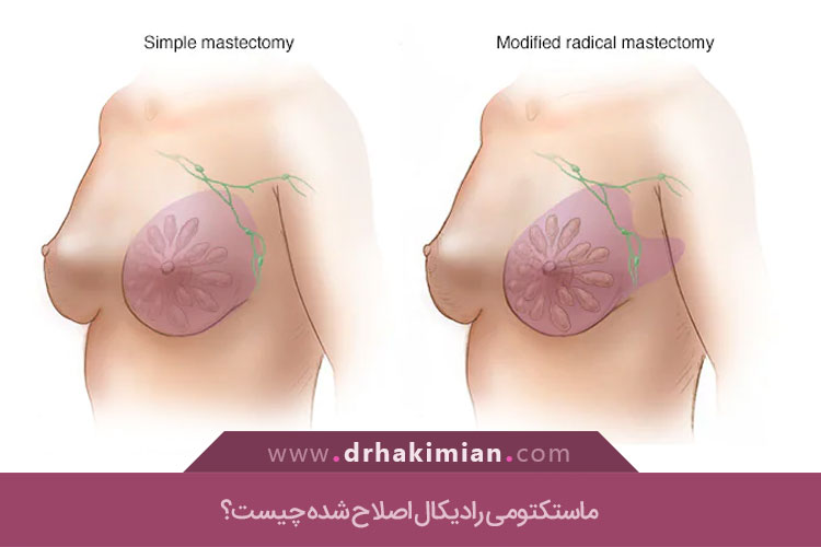 ماستکتومی رادیکال اصلاح شده