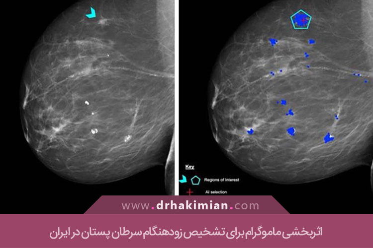 اثربخشی ماموگرام برای تشخیص زودهنگام سرطان پستان