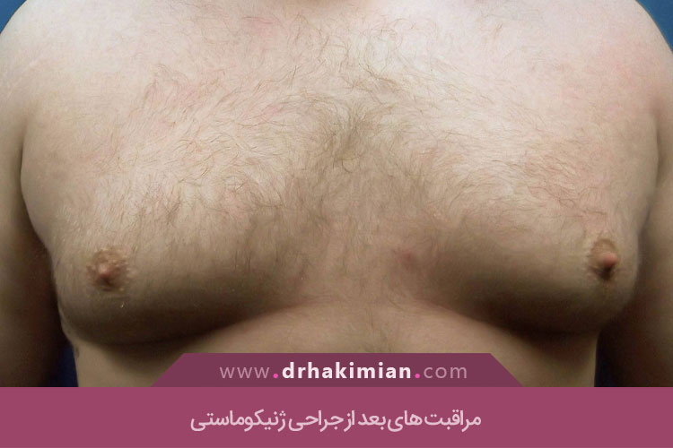 مراقبت های بعد از جراحی ژنیکوماستی