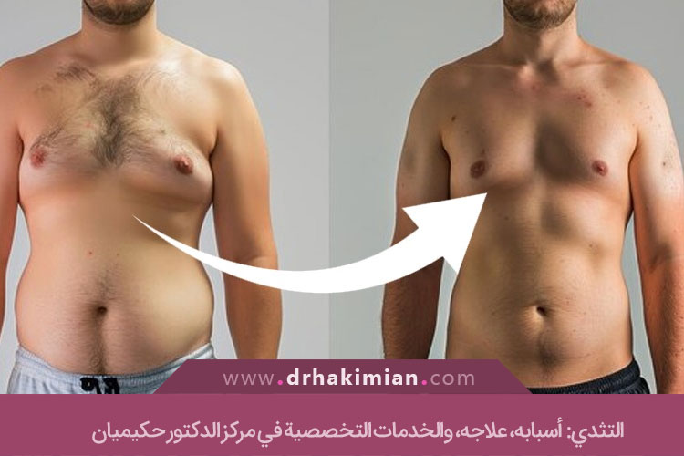 التثدي