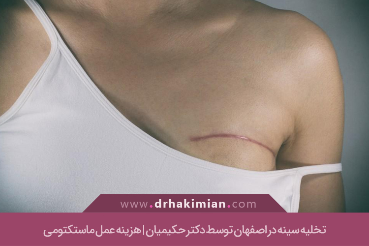 ماستکتومی در اصفهان