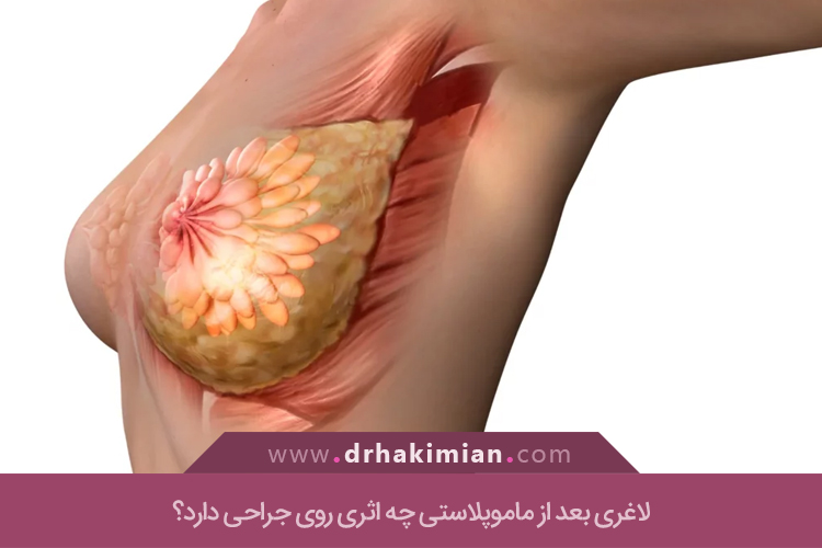 لاغری بعد از ماموپلاستی امکانپذیر است؟
