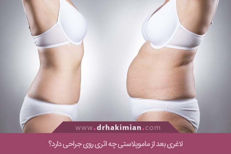 اشتباهات رایج در لاغری بعد از ماموپلاستی