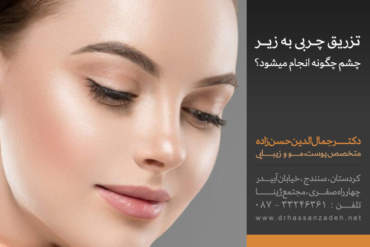 تزریق چربی زیر چشم