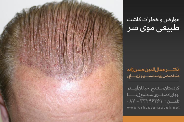 عوارض و خطرات کاشت طبیعی موی سر 
