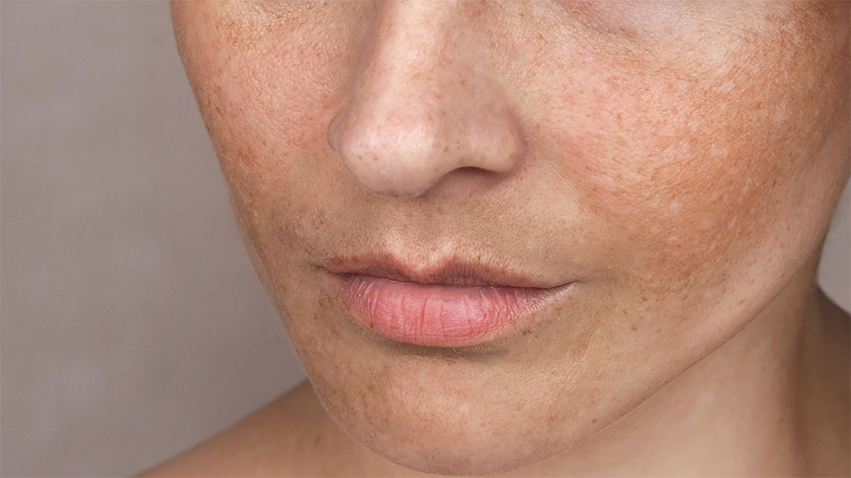 درمان لک صورت