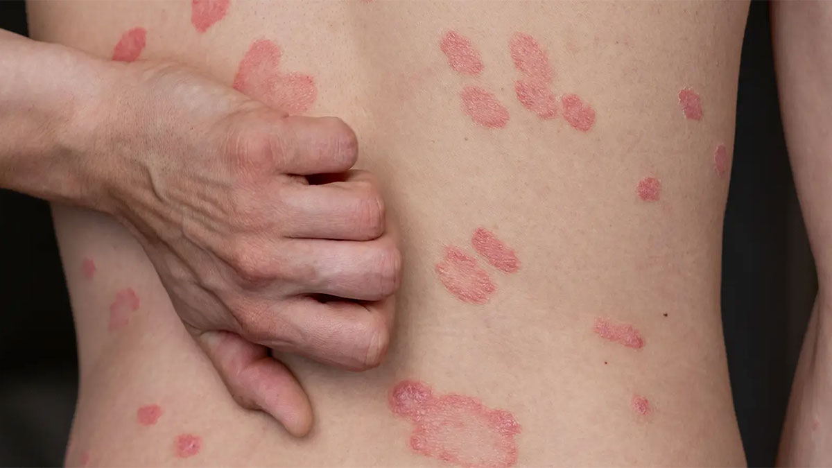 درمان لک پسوریازیس